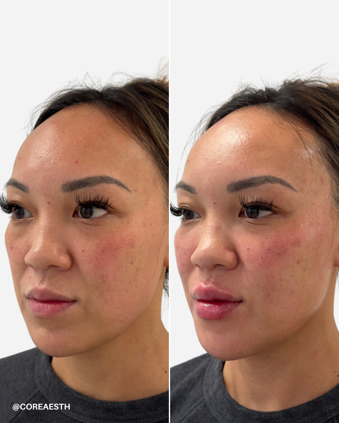 Before and after images of a woman's face, showing cosmetic enhancements to lips and skin.