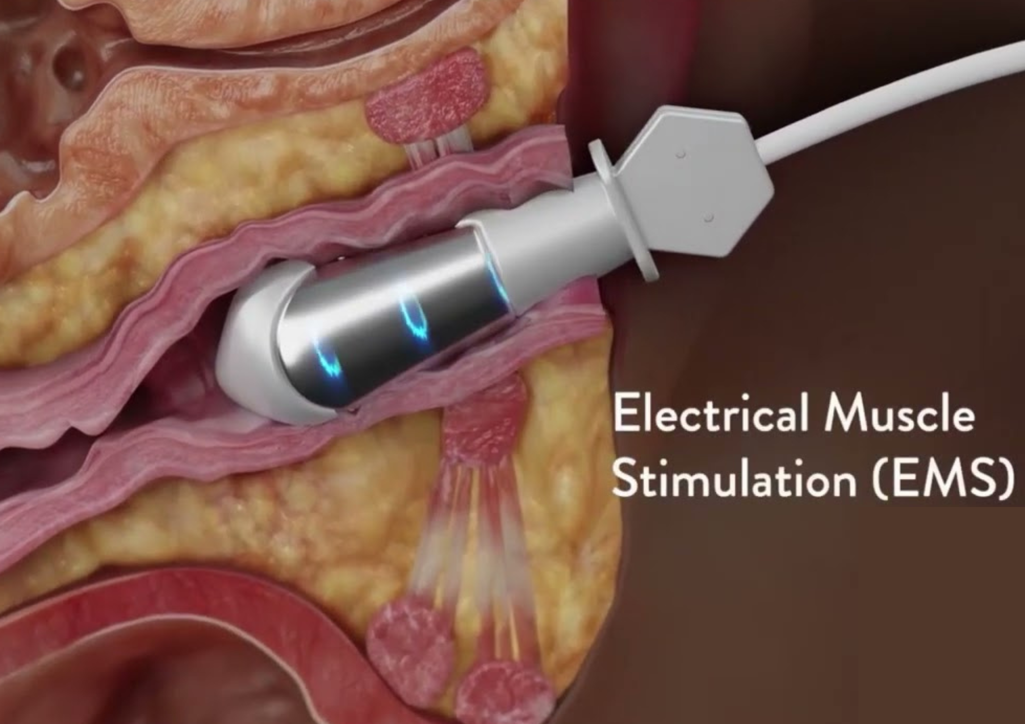 EMS For Vaginal Rejuvenation Core Aesthetic Medspa Weight Loss Clinic ems-for-vaginal-rejuvenation-core-aesthetic-medspa-weight-loss-clinic