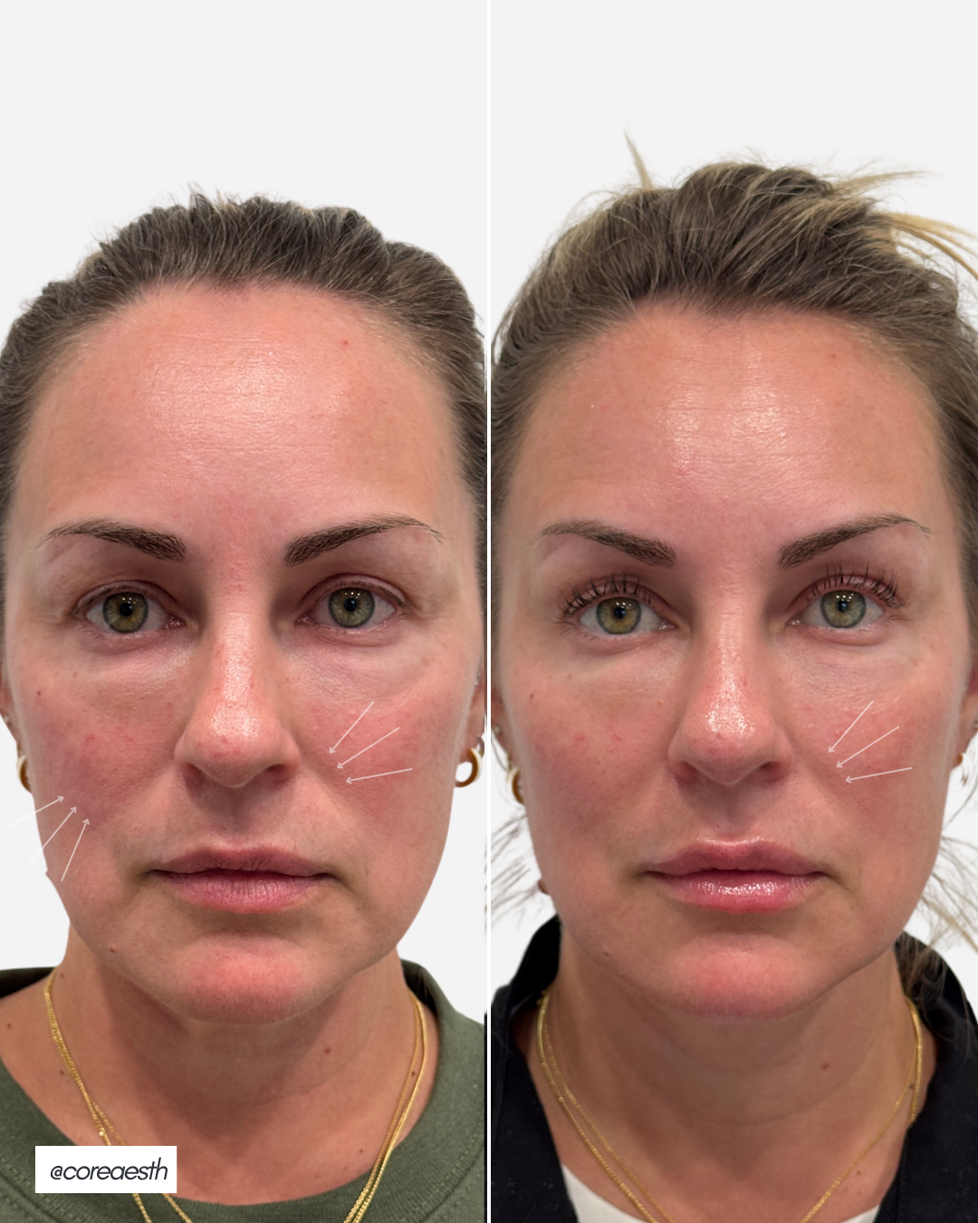 Before and after images of the same woman with noticeable skin improvements, showing reduced under-eye bags and smoother skin. The left image highlights target areas with arrows.