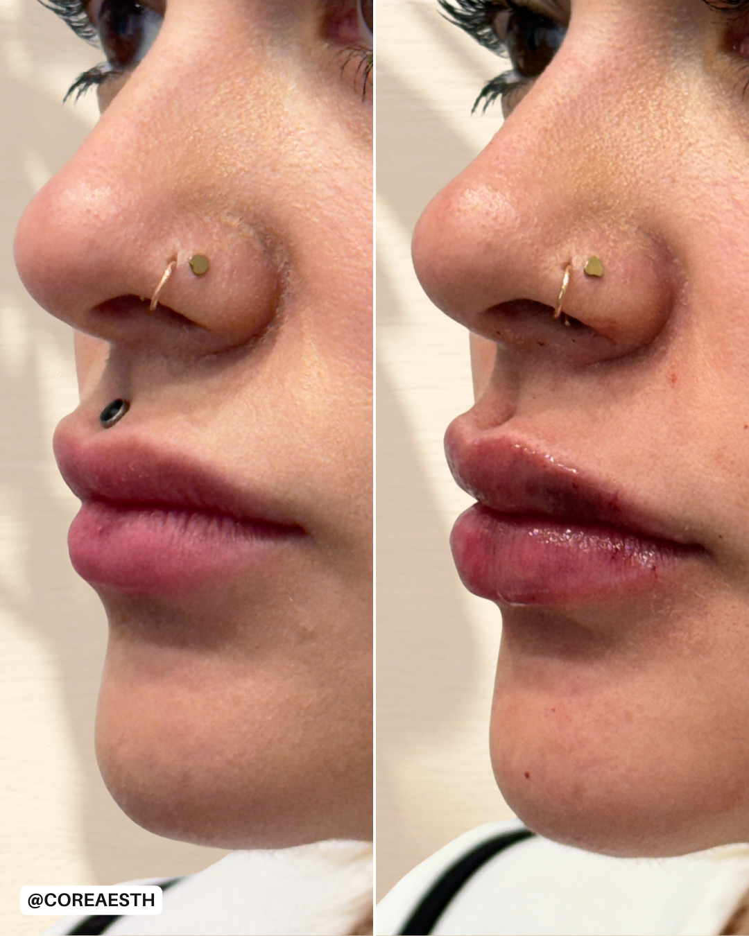 Side-by-side comparison of a person's profile featuring facial piercings and lip changes. Left side shows natural lips, right side shows plumped lips. The nose has a septum and a nostril piercing.