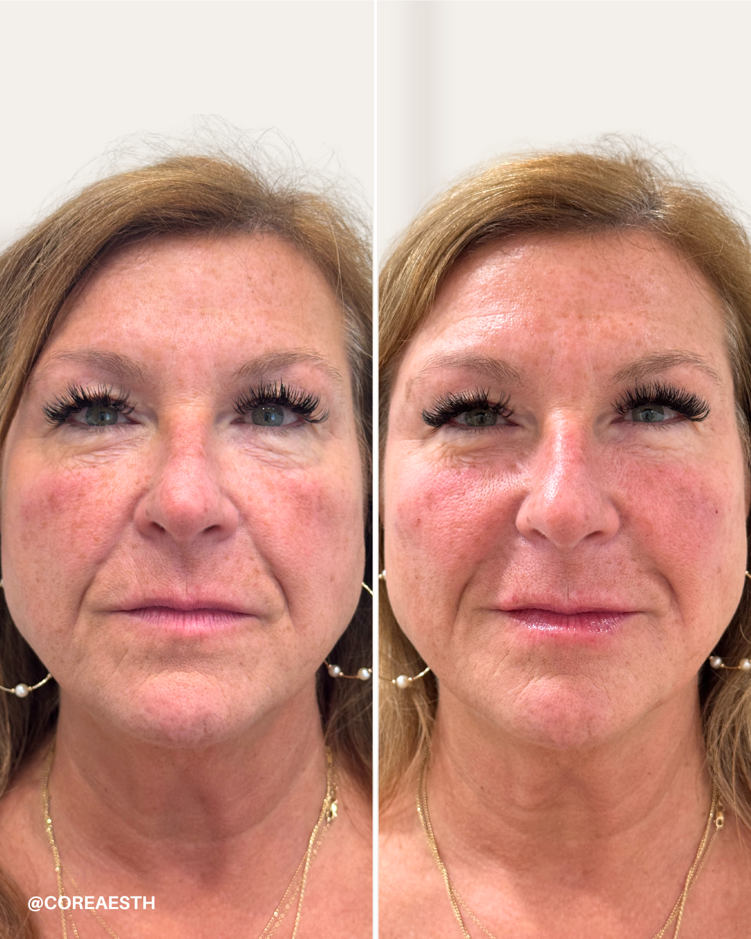 Side-by-side comparison of a woman's face before and after a cosmetic procedure, highlighting smoother skin and improved facial appearance.
