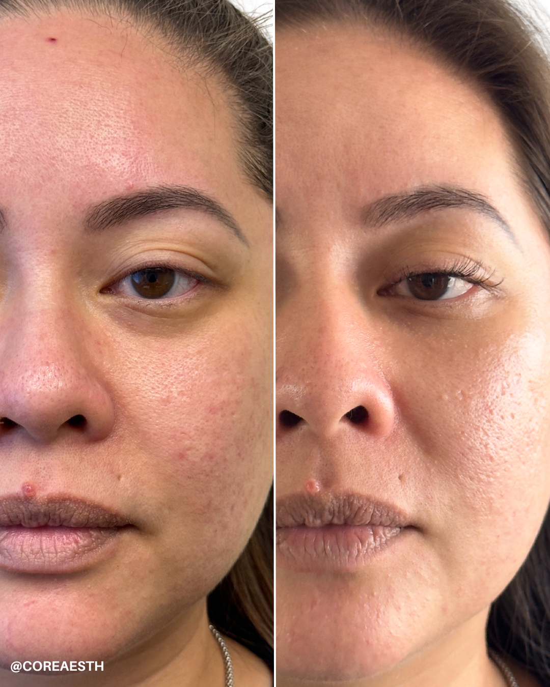 Before and after skin treatment photo showing face close-up with improved skin texture and reduced redness.
