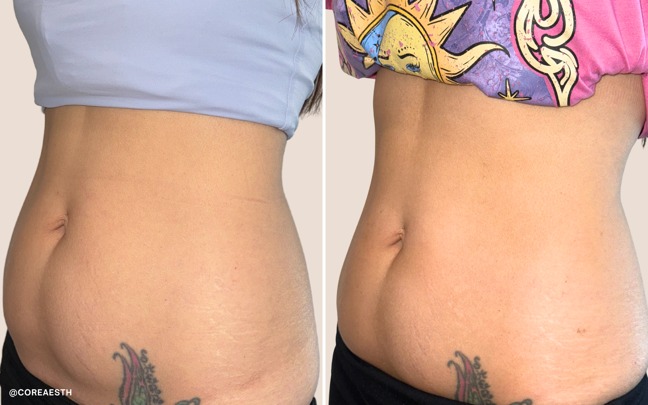 Before and after side-by-side comparison of a woman's abdomen showcasing weight loss or body contouring results.