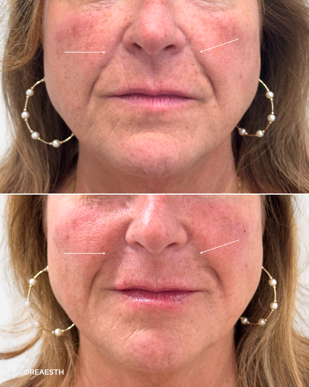 Before and after cosmetic treatment of a woman's face showing reduced wrinkles and improved skin tone.