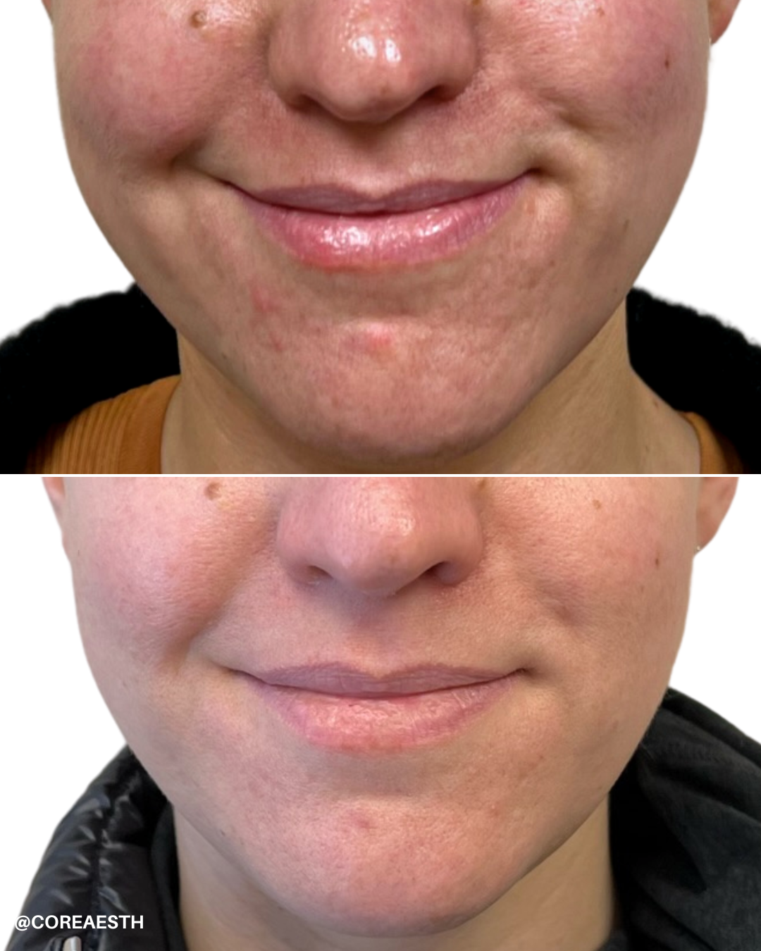 Side-by-side comparison of a person's lips and lower face, showing skin before and after treatment.