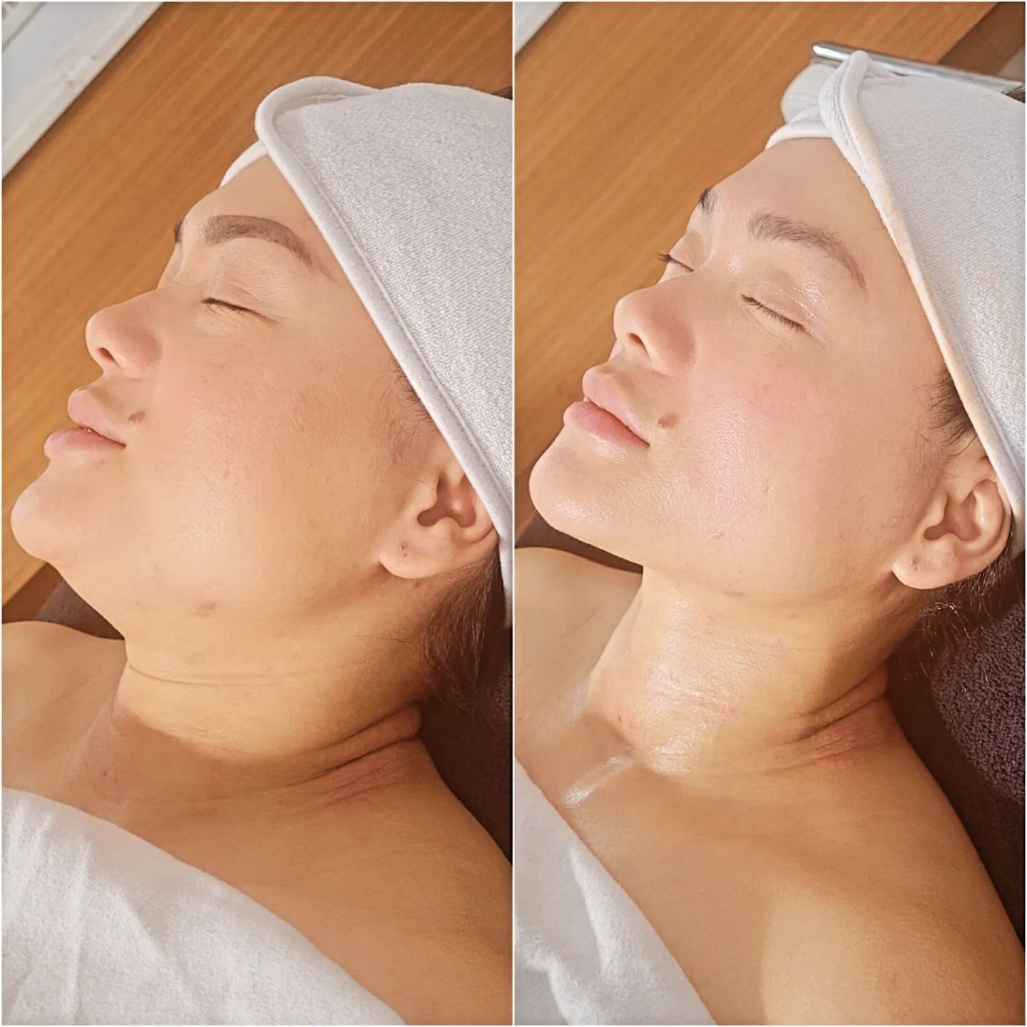 What is THE BUCCAL FACIAL?

A specialized technique using The LCD Method to help promote lymphatic flow, stimulate collagen and reduce tension on the muscles. 

✨ Benefits:
1️⃣ Enhanced Definition: Say goodbye to sagging skin and hello to a more defi