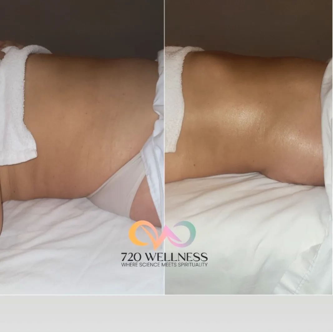 INFLAMMATION can cause WATER RETENTION!!
Did you know that inflammation in the body can lead to water retention, causing bloating and puffiness? Stress, poor diet, and hormonal changes can also contribute to this discomfort. Luckily, Brazilian lympha