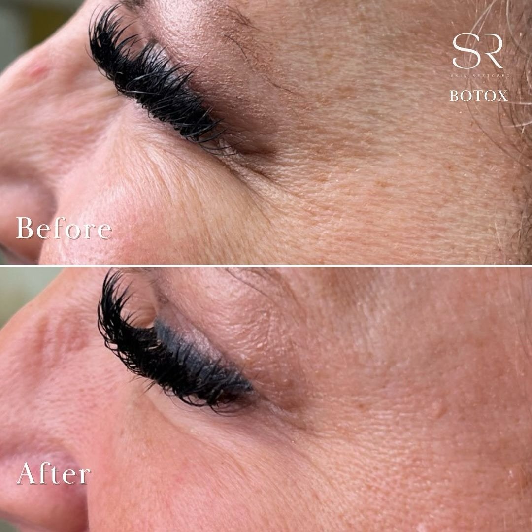 Ready to embrace a younger, more refreshed you? Our Botox treatments can help smooth away those fine lines and wrinkles, revealing a more youthful, radiant you! See the amazing before and after results! 💫 Book your appointment today and let's enhanc