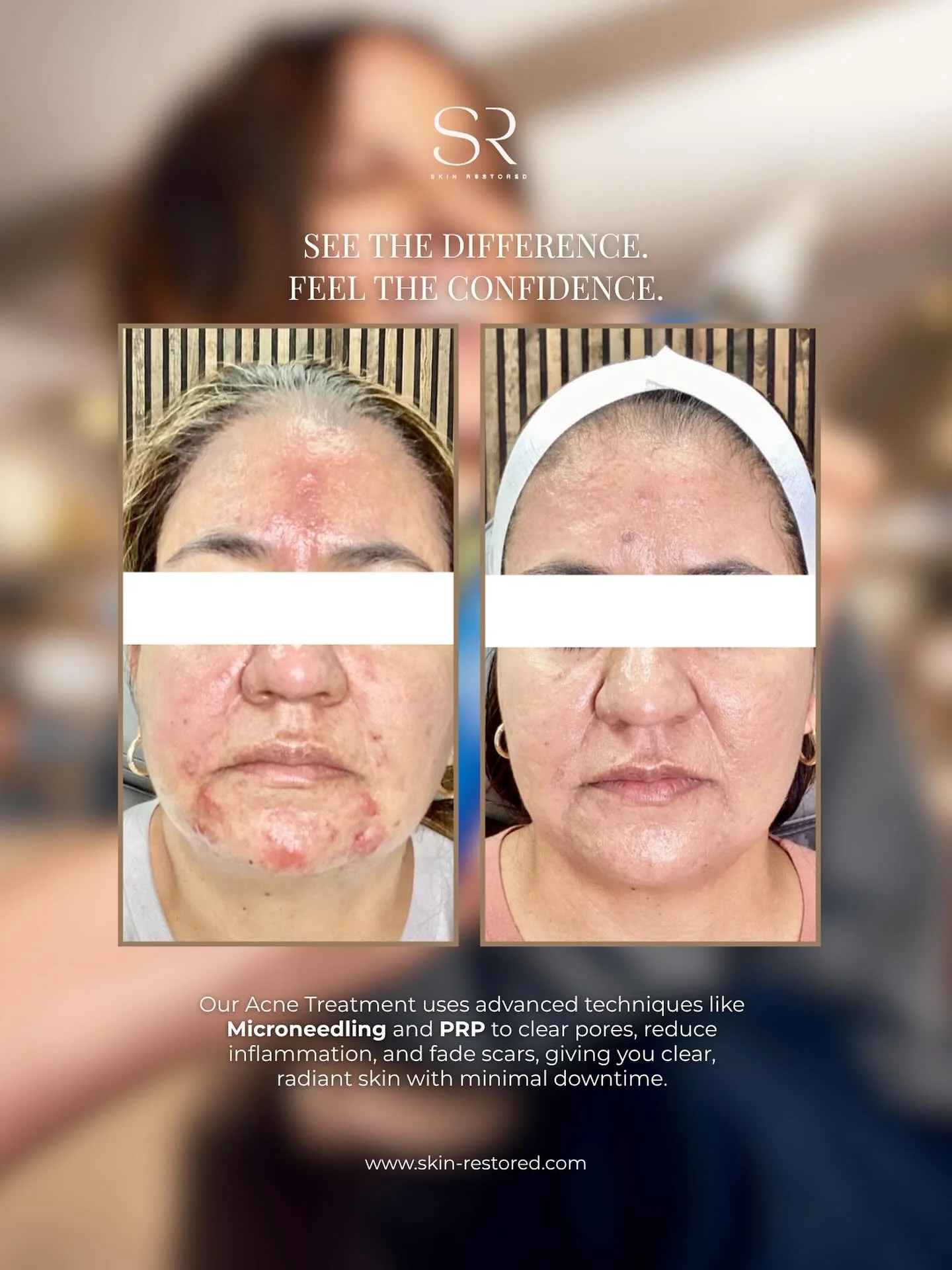 See the Difference. Feel the Confidence.
Our acne treatment uses Microneedling and PRP to reduce breakouts, fade scars, and restore clarity — with minimal downtime.
Get ready for clear, radiant skin just in time for the BIGGEST SALE OF THE YEA