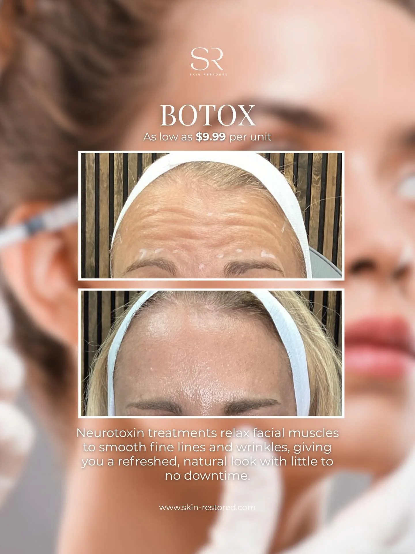Say goodbye to fine lines and hello to refreshed, natural-looking results with Botox — now as low as $9.99 per unit! 💉
Experience a rejuvenated look that’s effortless, elegant, and completely you.
Little to no downtime — just real