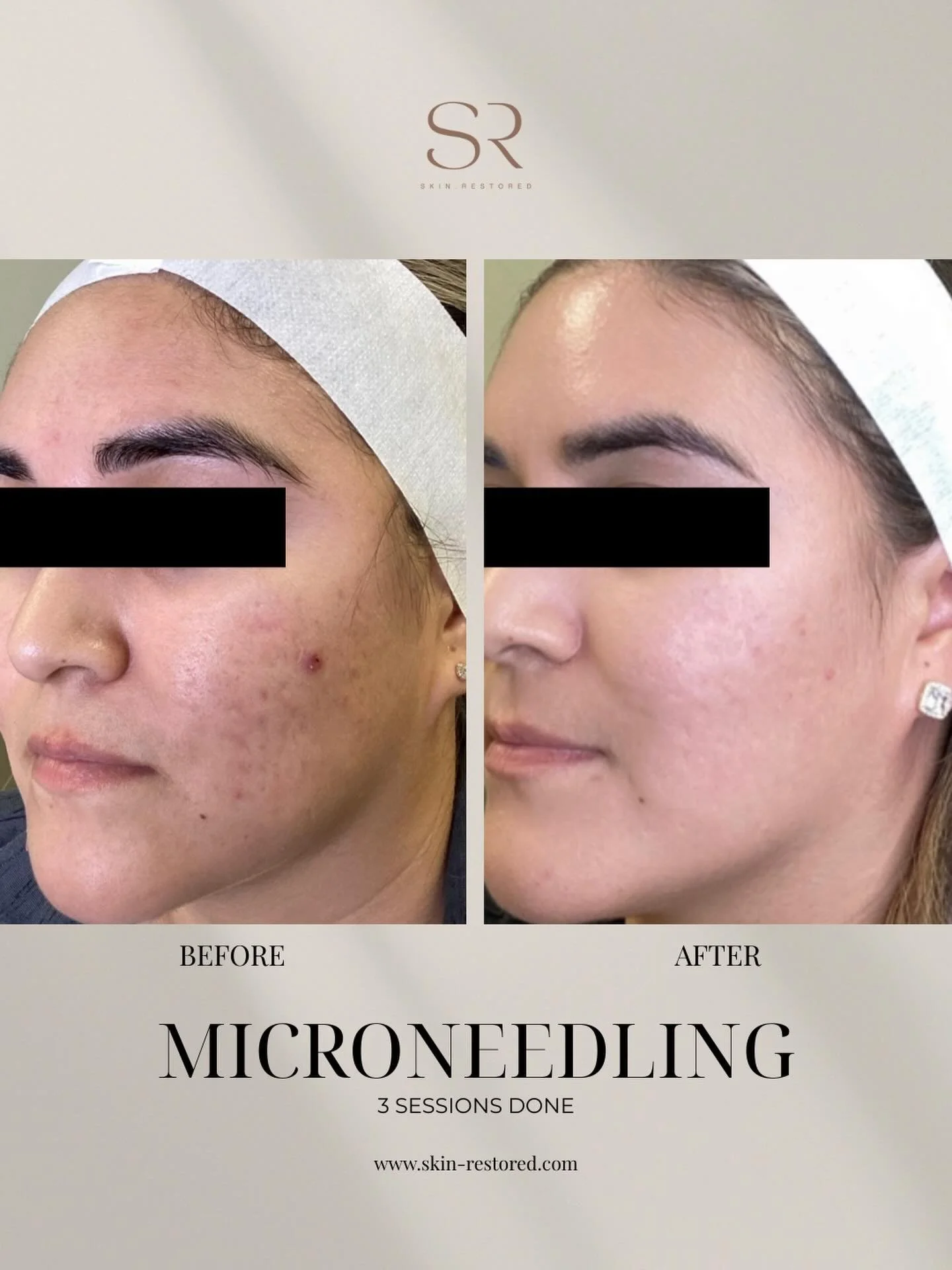 Check out these glowing results after just 3 Microneedling sessions! From acne scars to smoother, more radiant skin, Microneedling helps boost collagen and rejuvenate your complexion.

Book now and enjoy a $100 rebate, available until December 25 onl
