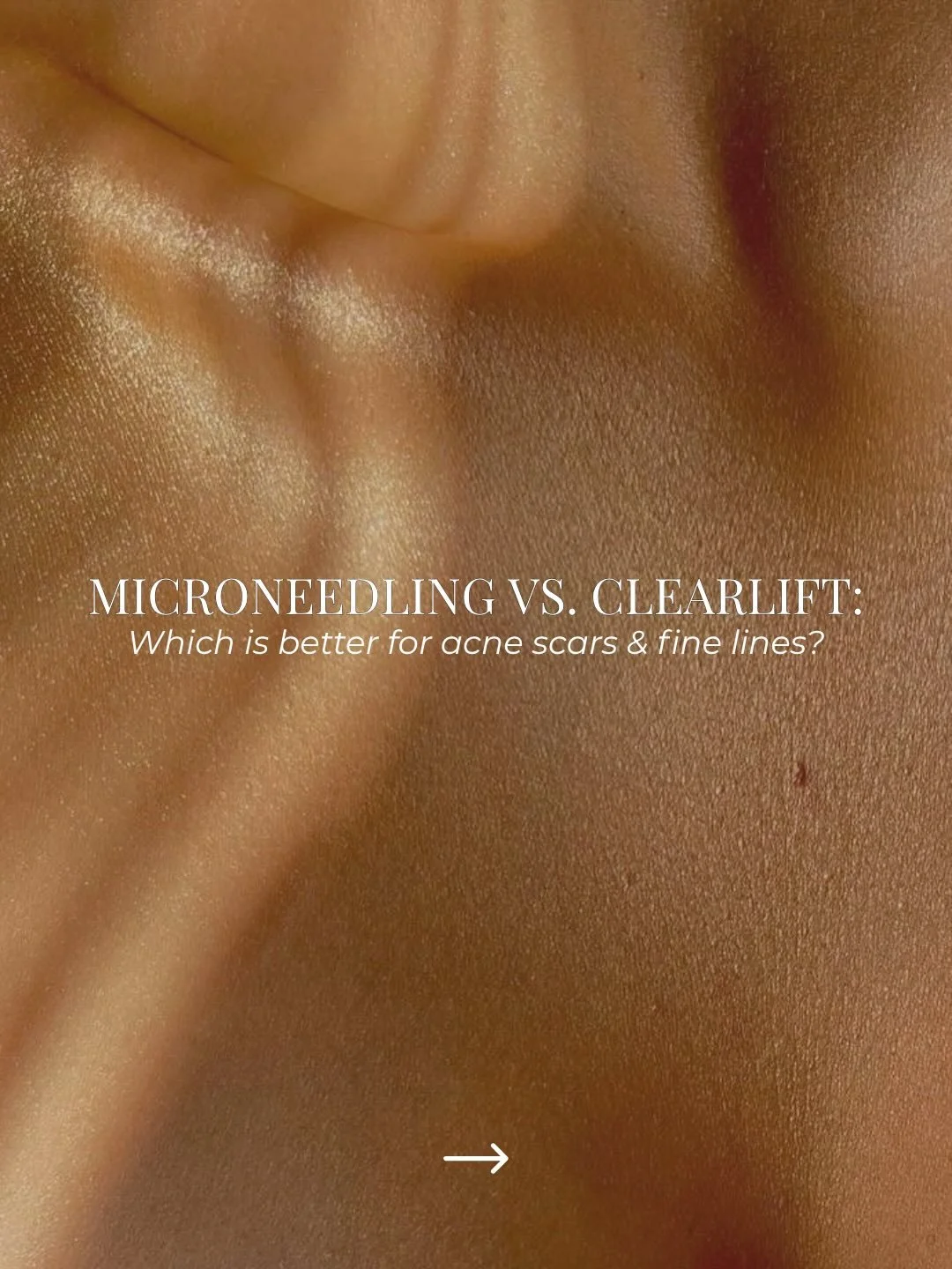 Microneedling or Clearlift? The answer depends on your skin goals ✨

Both treatments stimulate collagen, but they work in different ways and target different concerns.

Not sure which one is right for you? Many clients see the best results by combini