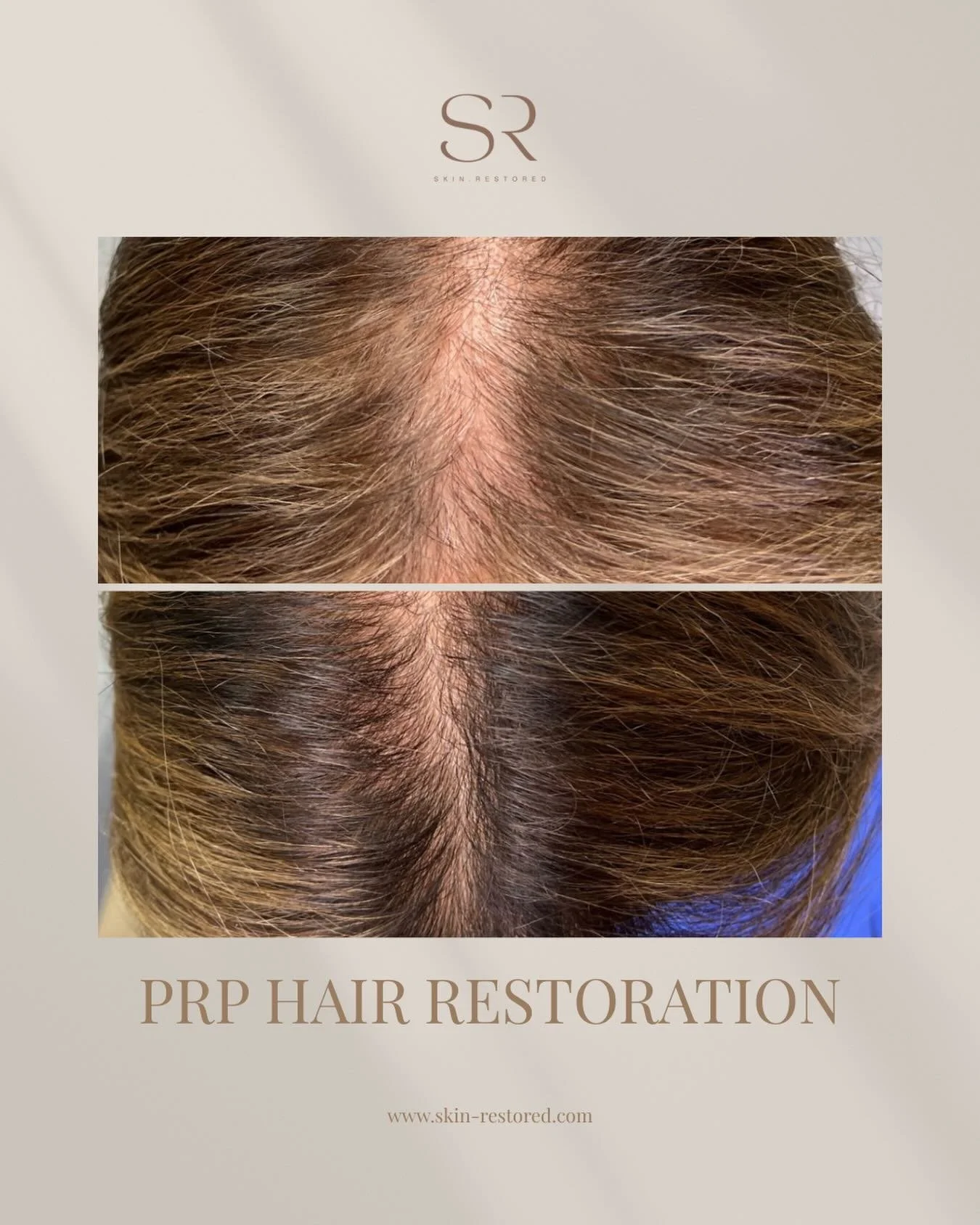 If you&rsquo;ve been noticing more hair in the shower&hellip; or your part looking a little wider than before&hellip; you&rsquo;re not alone. 

PRP Hair Restoration is one of our favorite solutions because it uses your own plasma to wake up sluggish 
