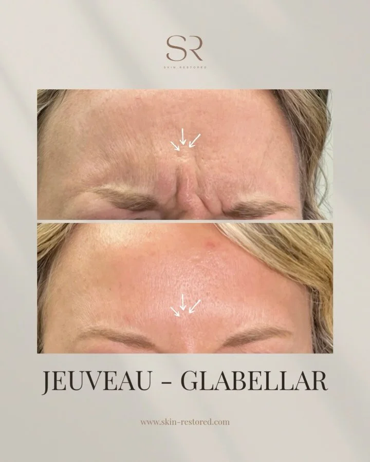 Jeuveau for Smooth, Wrinkle-Free Skin! ✨

Take advantage of our Jeuveau Month-Long Promo and unlock flawless, rejuvenated skin! For a limited time, buy 40 units and get 15 FREE!

Smooth those forehead lines and glabella wrinkles for a refreshed, youn
