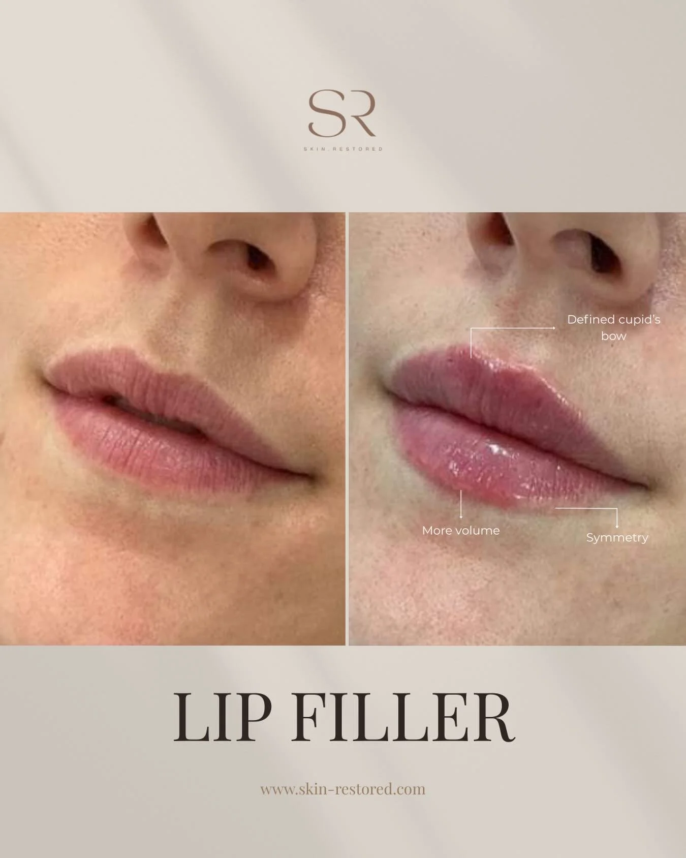Transform your smile with our Lip Filler treatment!

Check out these stunning transformation. Perfectly defined Cupid&rsquo;s bow, added volume, and flawless symmetry. Whether you&rsquo;re looking for subtle enhancement or a more dramatic change, our