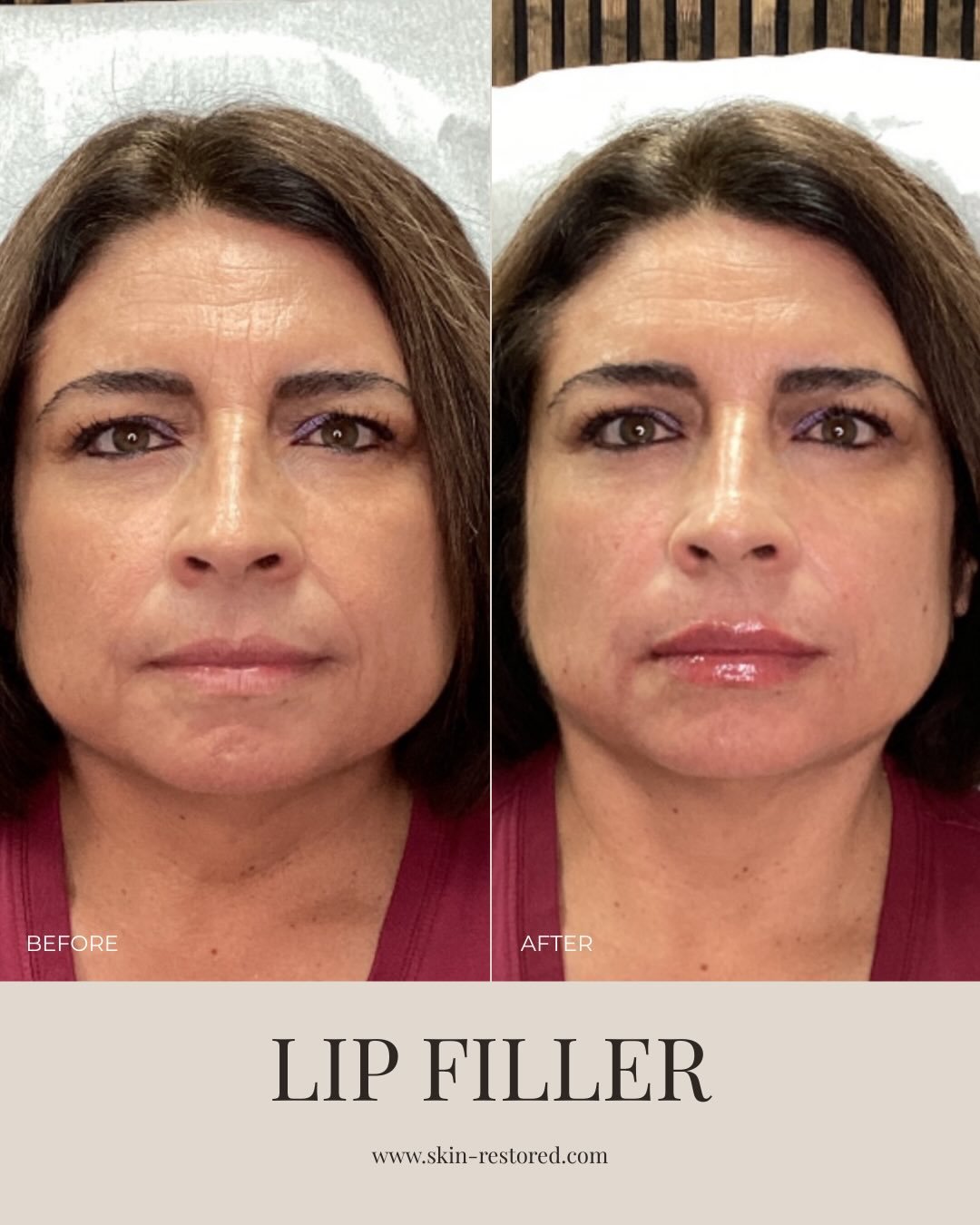 Defined edges. Smooth hydration. A youthful finish that still feels like you.

If you&rsquo;ve been thinking about enhancing your lips in a subtle, balanced way, this is your moment. Join us Thursday, January 29th and enjoy 50% off lip filler! 👄💉

