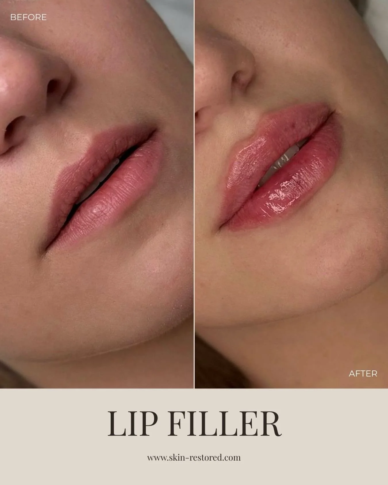 Get your perfect lips just in time for Valentine&rsquo;s 💋

Because soft, natural-looking lips deserve a little extra time. This lip filler treatment is all about balanced definition, hydration, and results that enhance your natural features without