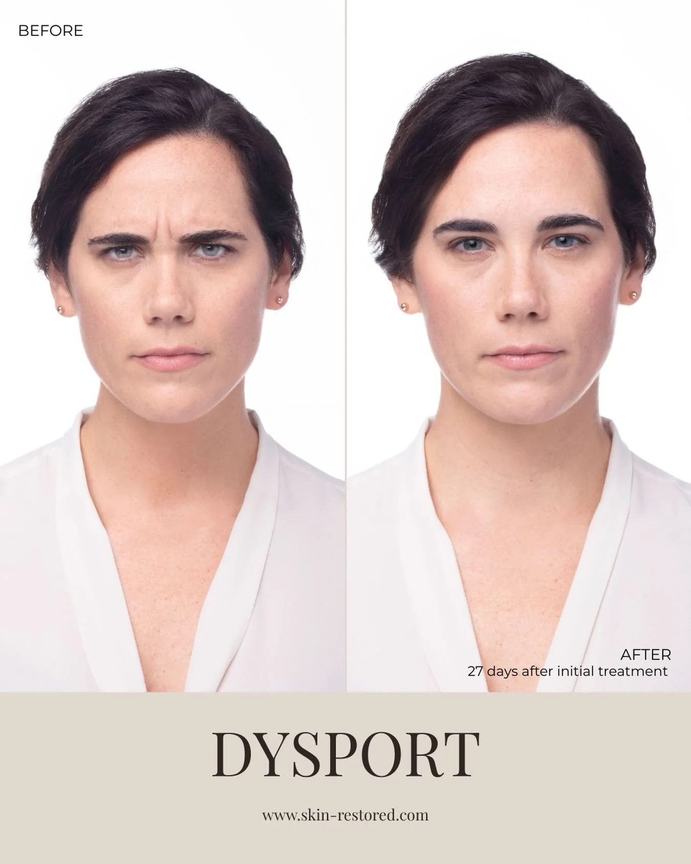 Frown lines softened. Expression refreshed. Confidence restored. ✨

Dysport works by relaxing the muscles that cause lines between the brows, helping you look more relaxed without looking frozen. These results are just 27 days after treatment and onl