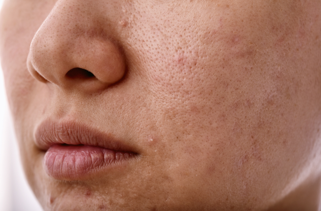 Dealing With Uneven Skin Texture: Expert-Recommended Treatments