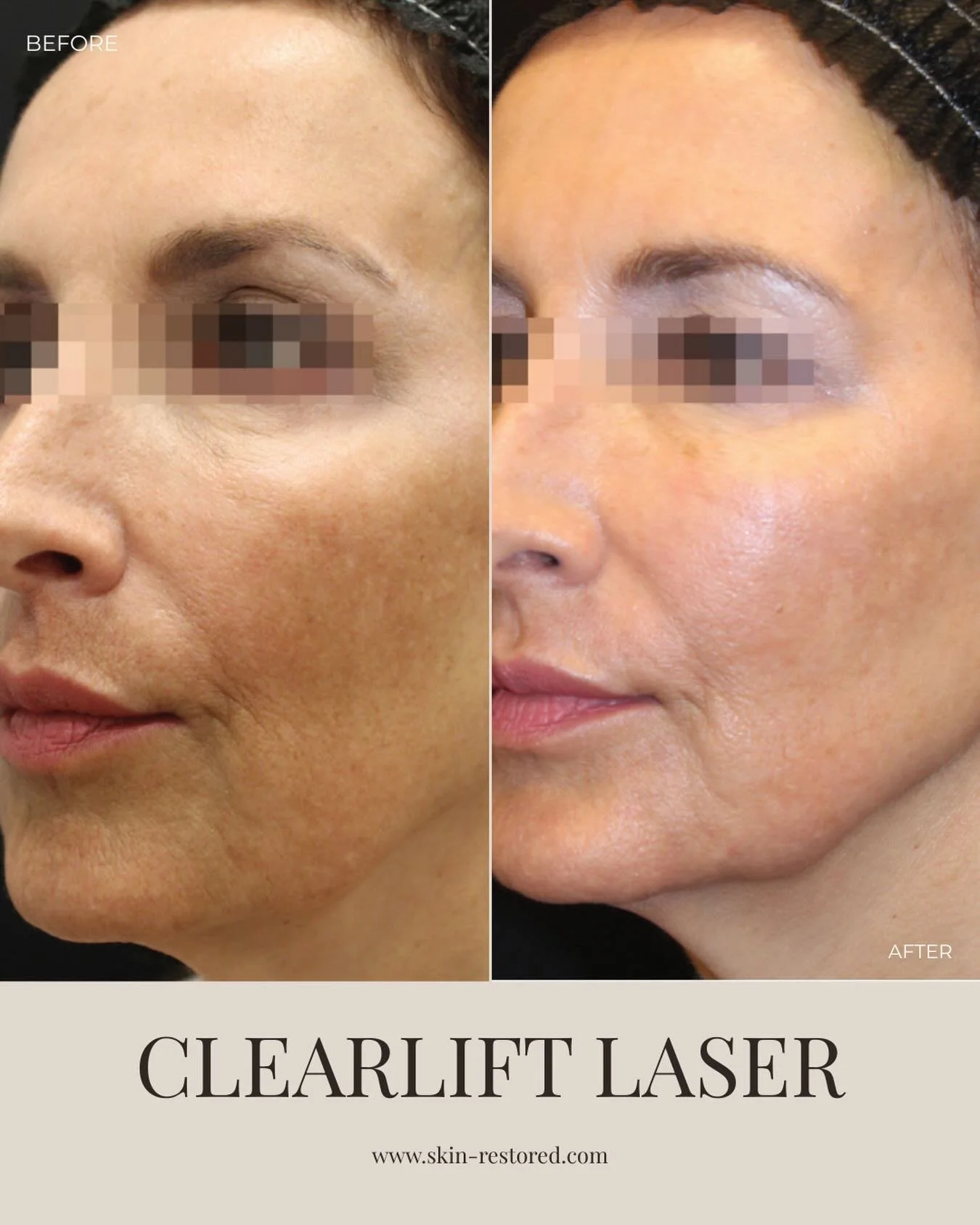 Clearlift Laser works below the surface to wake up your collagen, smooth texture, soften fine lines, and brighten pigmentation&hellip; all with little to no downtime.

No drastic change.
No overdone look.
Just firmer, smoother, healthier-looking skin