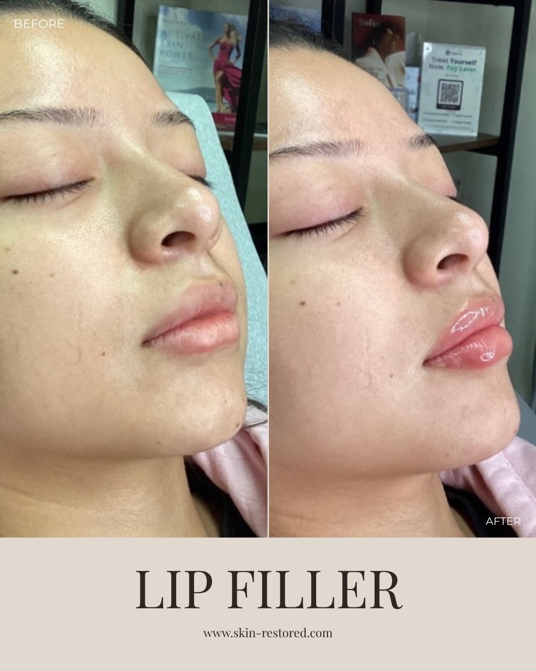 Lip filler isn&rsquo;t about making your lips look different. It&rsquo;s about enhancing what&rsquo;s already there. A little structure. A little hydration. A smoother, more defined finish.

We focus on natural proportions and precision so your resul