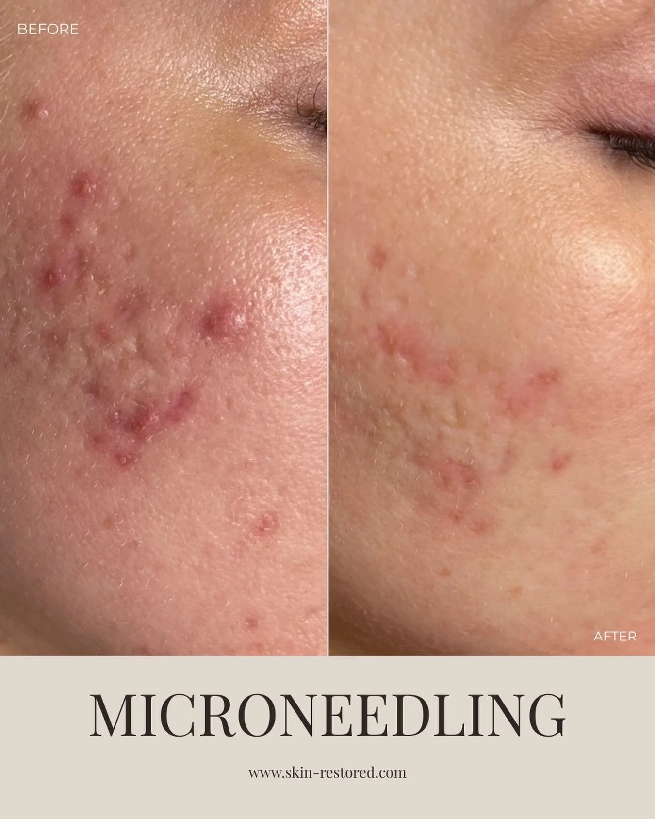 This is what commitment to your skin looks like.

Real change doesn&rsquo;t happen overnight. It happens with the right provider and a consistent plan.

If acne scarring or texture has been bothering you, let&rsquo;s correct it the right way.

✨ Book