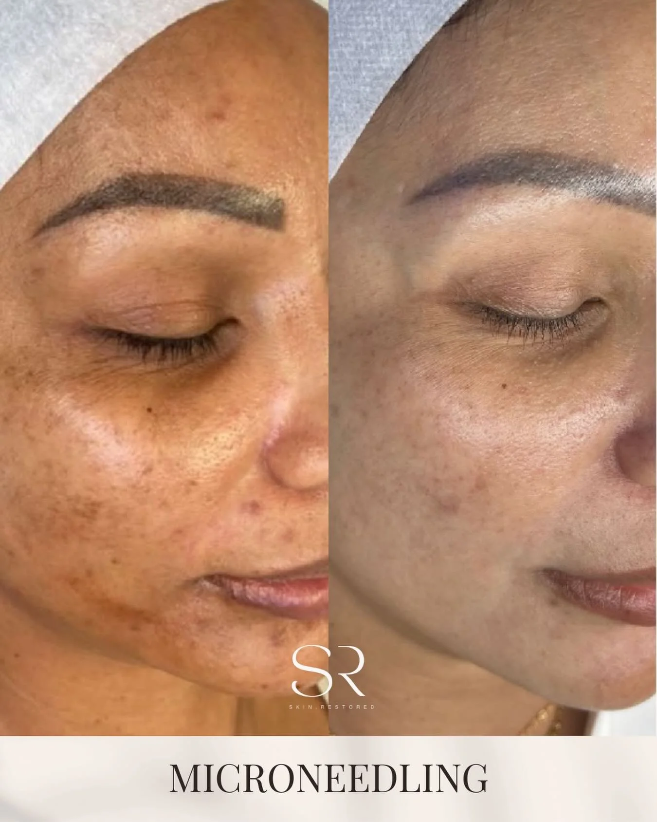 Entering March with intention.

This is not the month for trends. This is the month for restoration.

If you want brighter, firmer, more even skin by summer, the work starts now. Microneedling series, pigment correction, collagen stimulation, and per