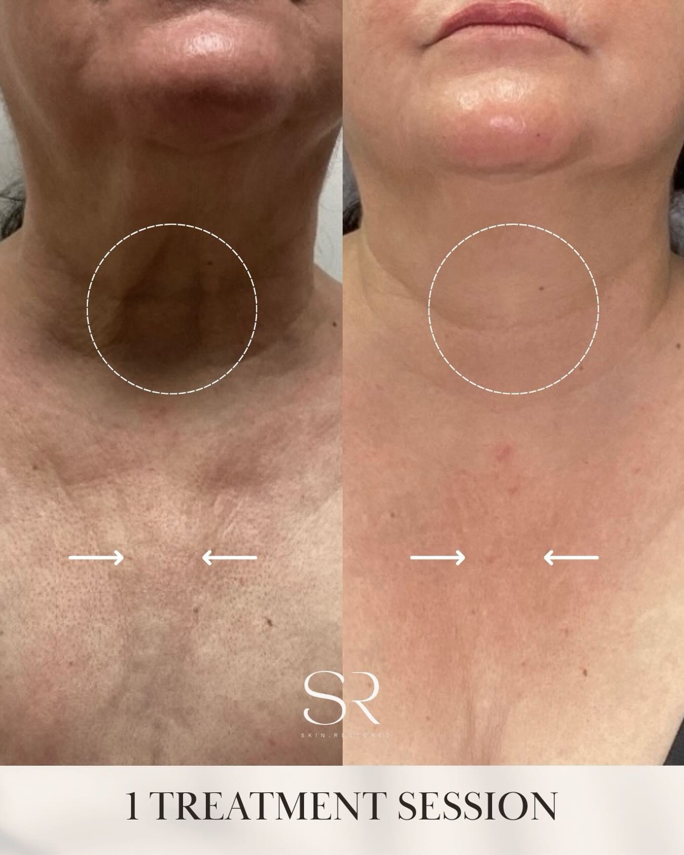 The neck often reveals aging before the face does.

Why?
The skin here is thinner, produces less oil, and loses collagen more quickly. Over time, that leads to crepey texture, horizontal lines, and laxity.

Microneedling works by creating controlled 