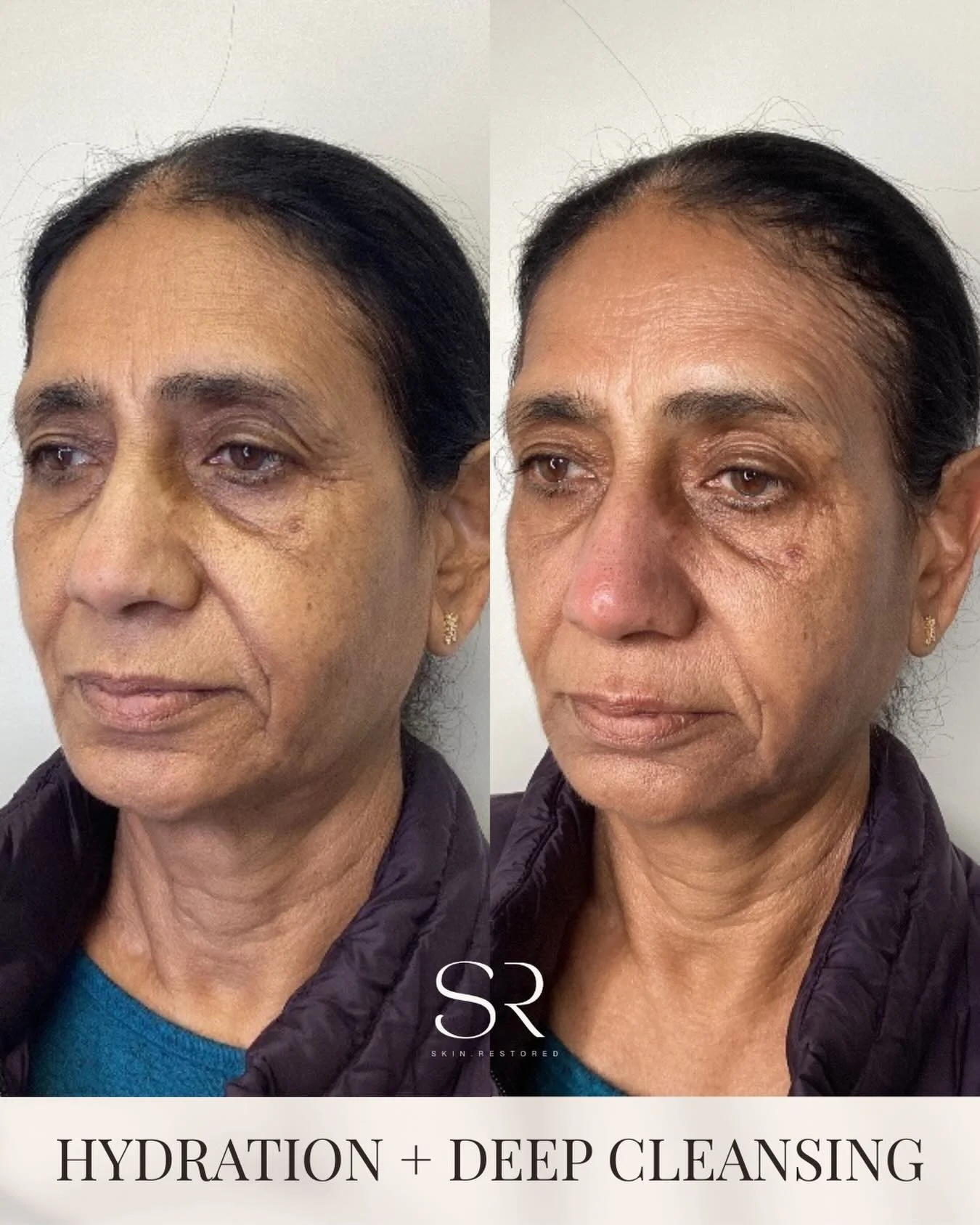 Hydration and deep cleansing can make a noticeable difference in the skin&rsquo;s texture and radiance. This result was achieved with a HydraFacial, helping remove buildup while replenishing the skin with essential hydration.

For the month of March,