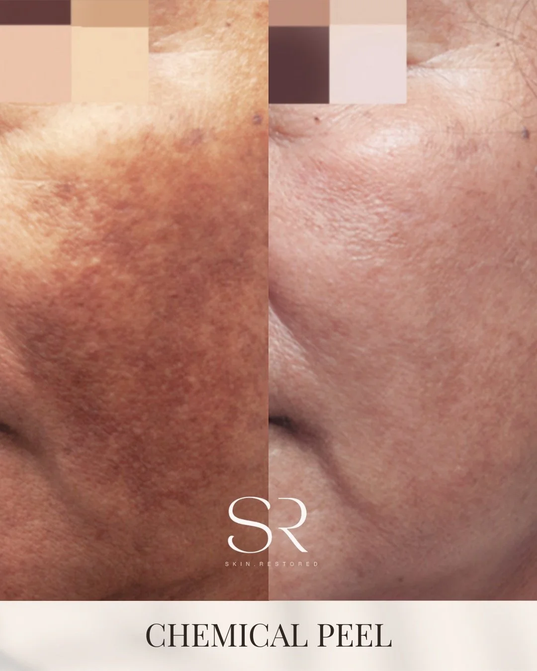 Hyperpigmentation happens when excess melanin forms in the skin. This can be triggered by sun exposure, inflammation, acne, or hormonal changes, leaving behind dark spots and uneven tone.

Chemical peels help improve hyperpigmentation by gently exfol