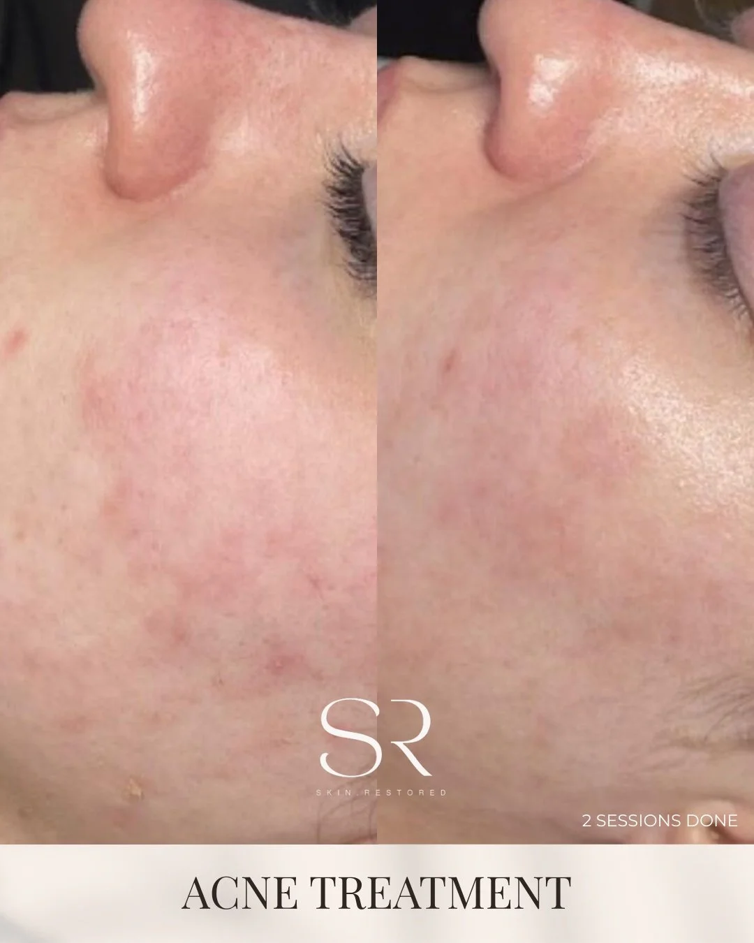 If acne marks are still showing months later&hellip; your skin may need support to renew.

Microneedling helps stimulate collagen and supports the skin&rsquo;s natural repair process, which may improve acne marks and skin texture over time.

This tra
