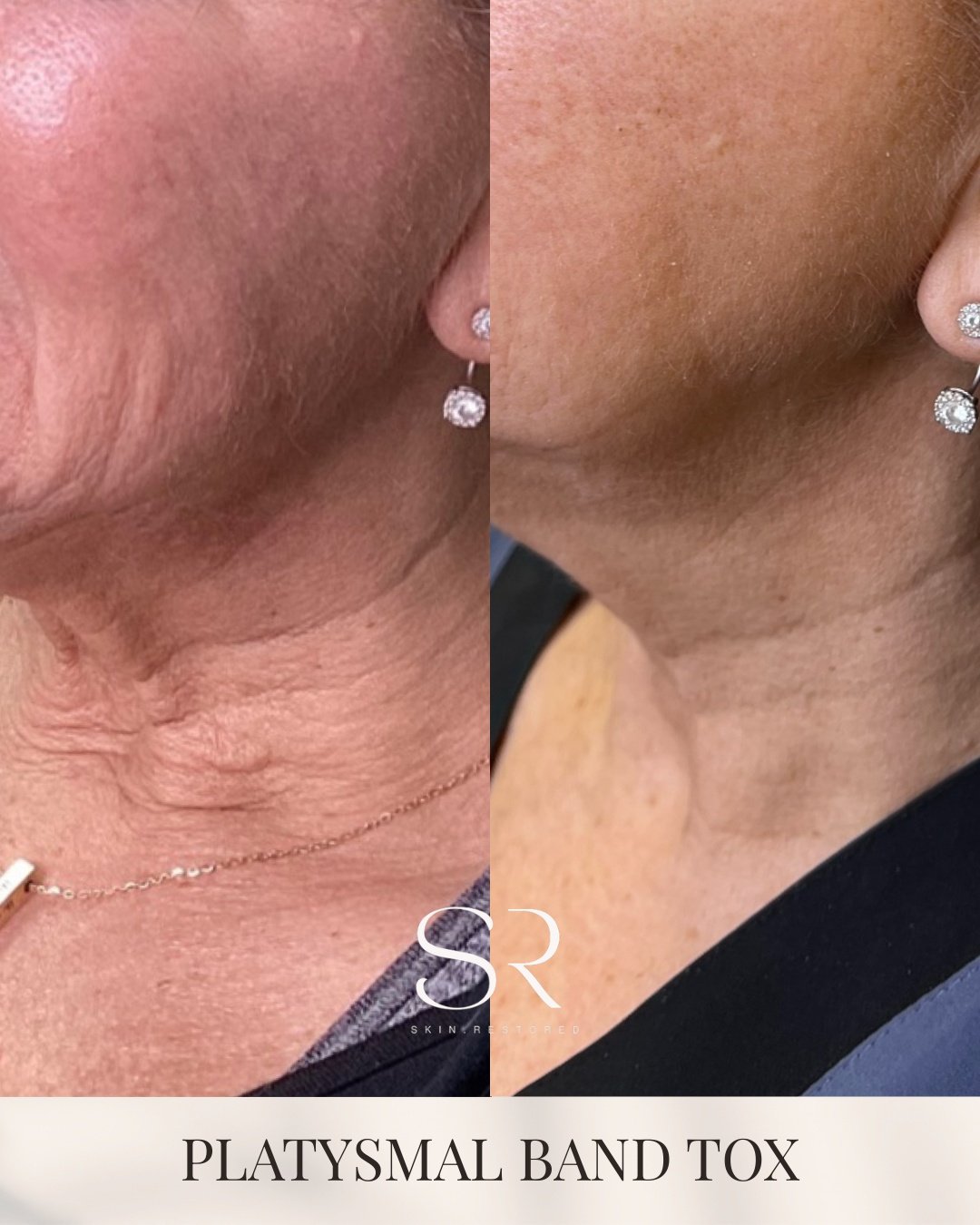 Those vertical neck bands you see when talking or smiling have a name.

They are called platysmal bands, caused by the platysma muscle in the neck becoming more visible over time as skin elasticity changes.

Platysmal Band Tox works by relaxing targe