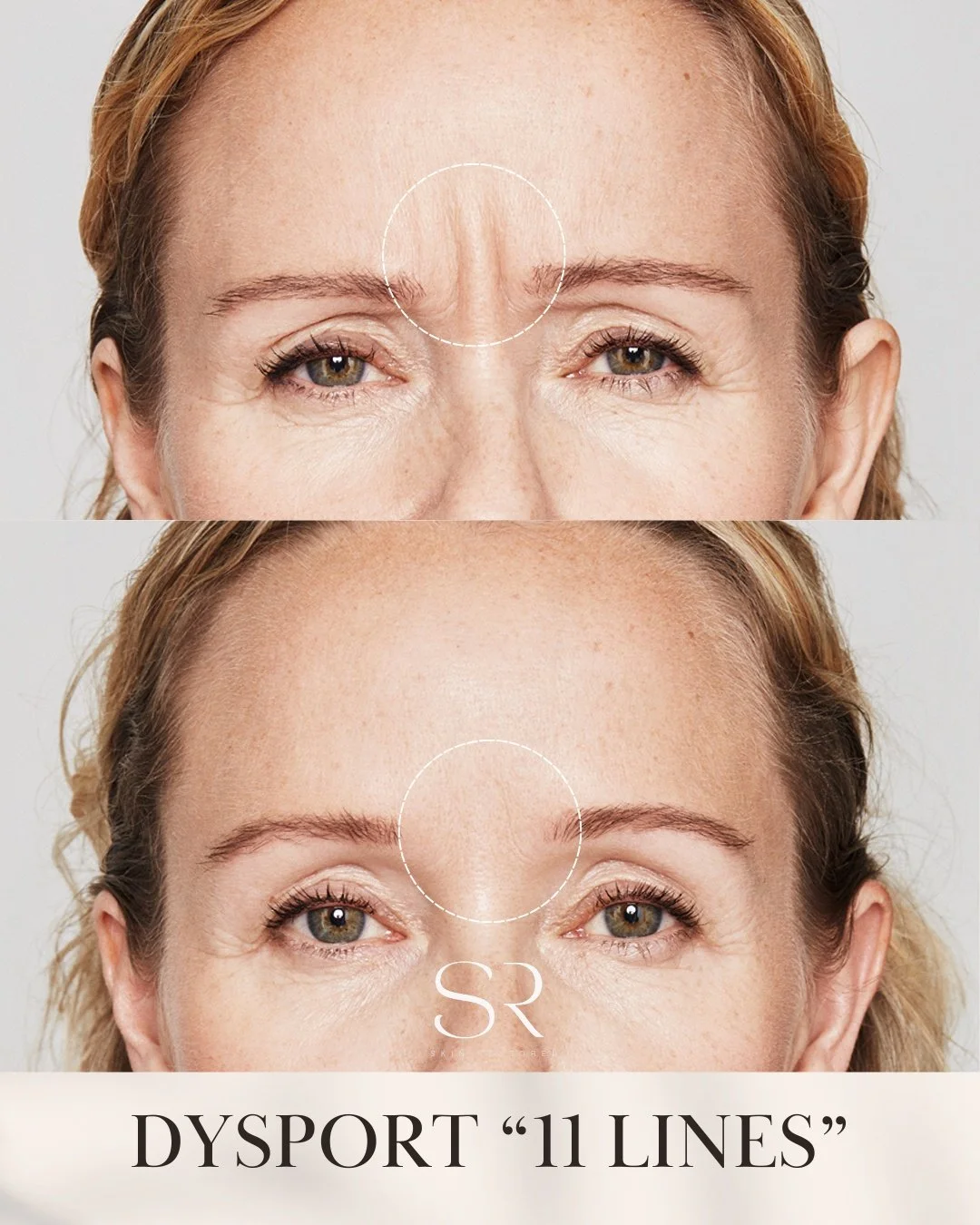 Those &ldquo;11 lines&rdquo; don&rsquo;t have to stay.

Dysport works by relaxing the muscles that cause deep frown lines, helping you look smoother, softer, and more refreshed without looking overdone.

For a limited time only this month:
Book 100 u