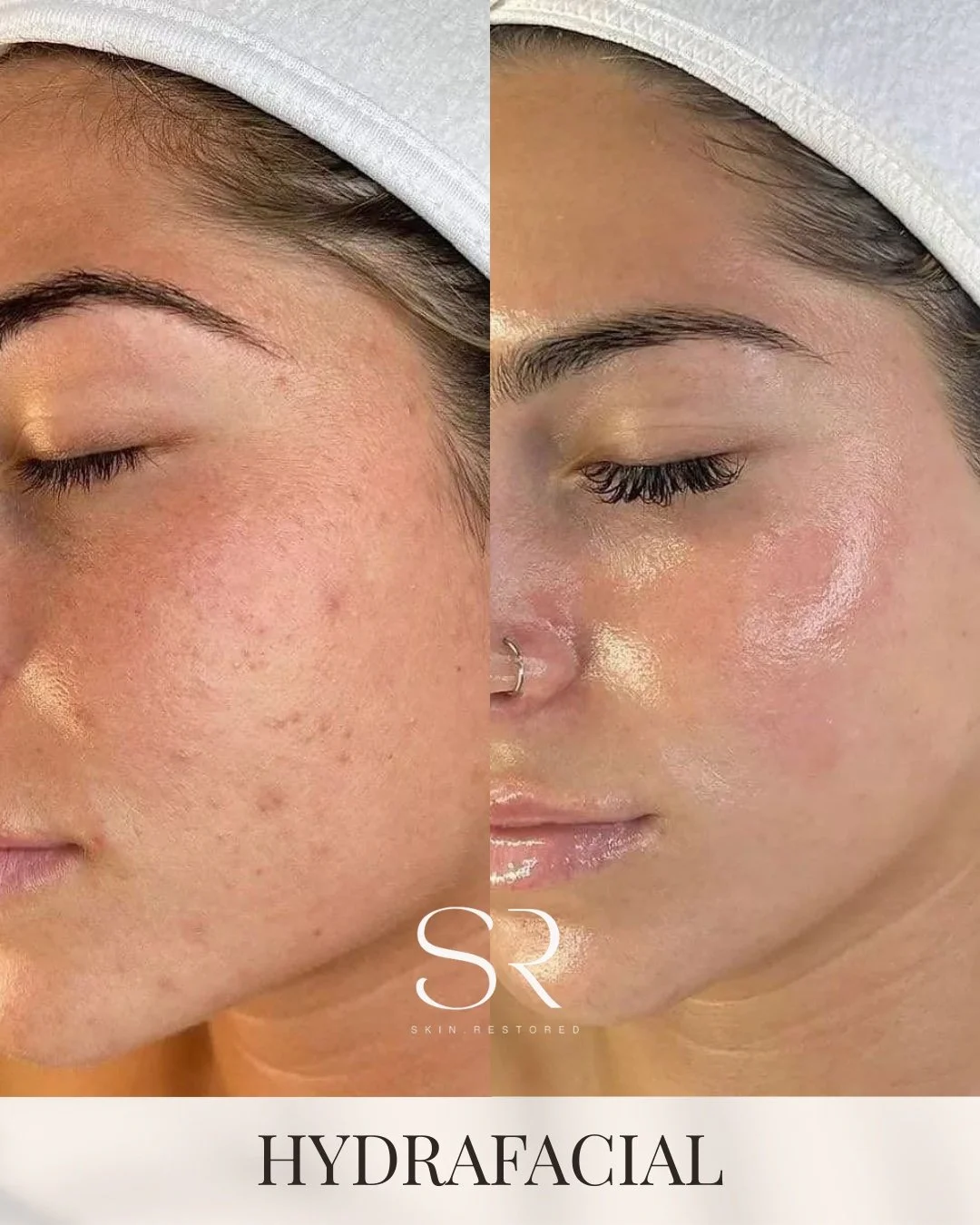 Your glow-up starts here ✨

From textured, dull skin to smooth, radiant, and glassy in just one session. This is what the right treatment can do when your skin is actually cared for, not just covered.

Our Hydrafacial deeply cleanses, exfoliates, and