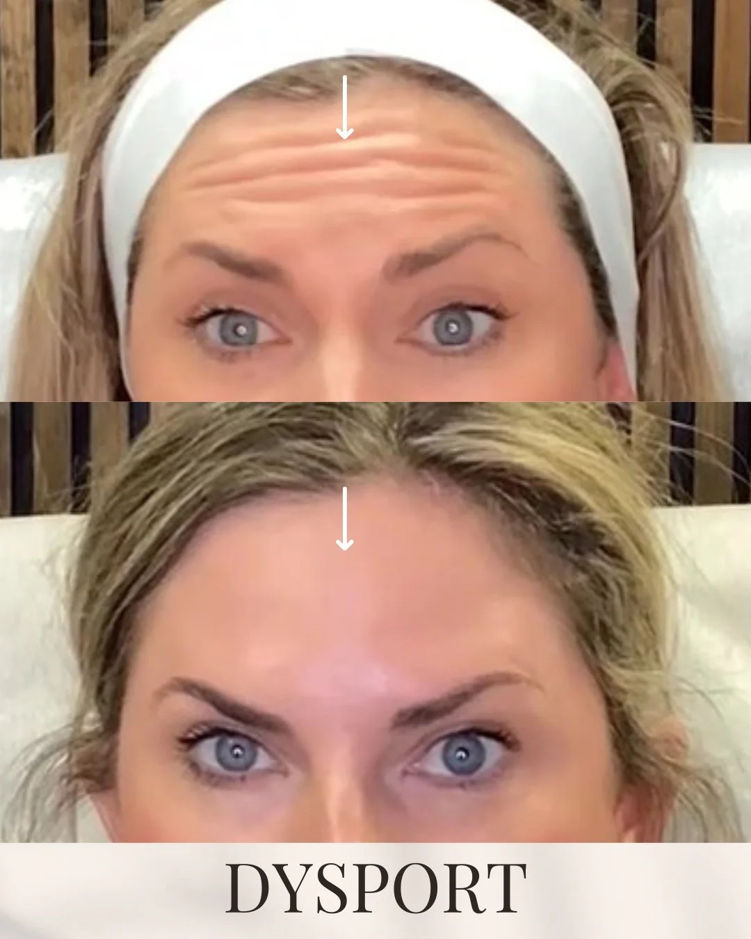 Still making that frown face? You don&rsquo;t have to ✨

Dysport helps soften lines by relaxing the muscles that cause them, especially in the forehead and between the brows. The result? Smoother skin that still looks natural, refreshed, and complete