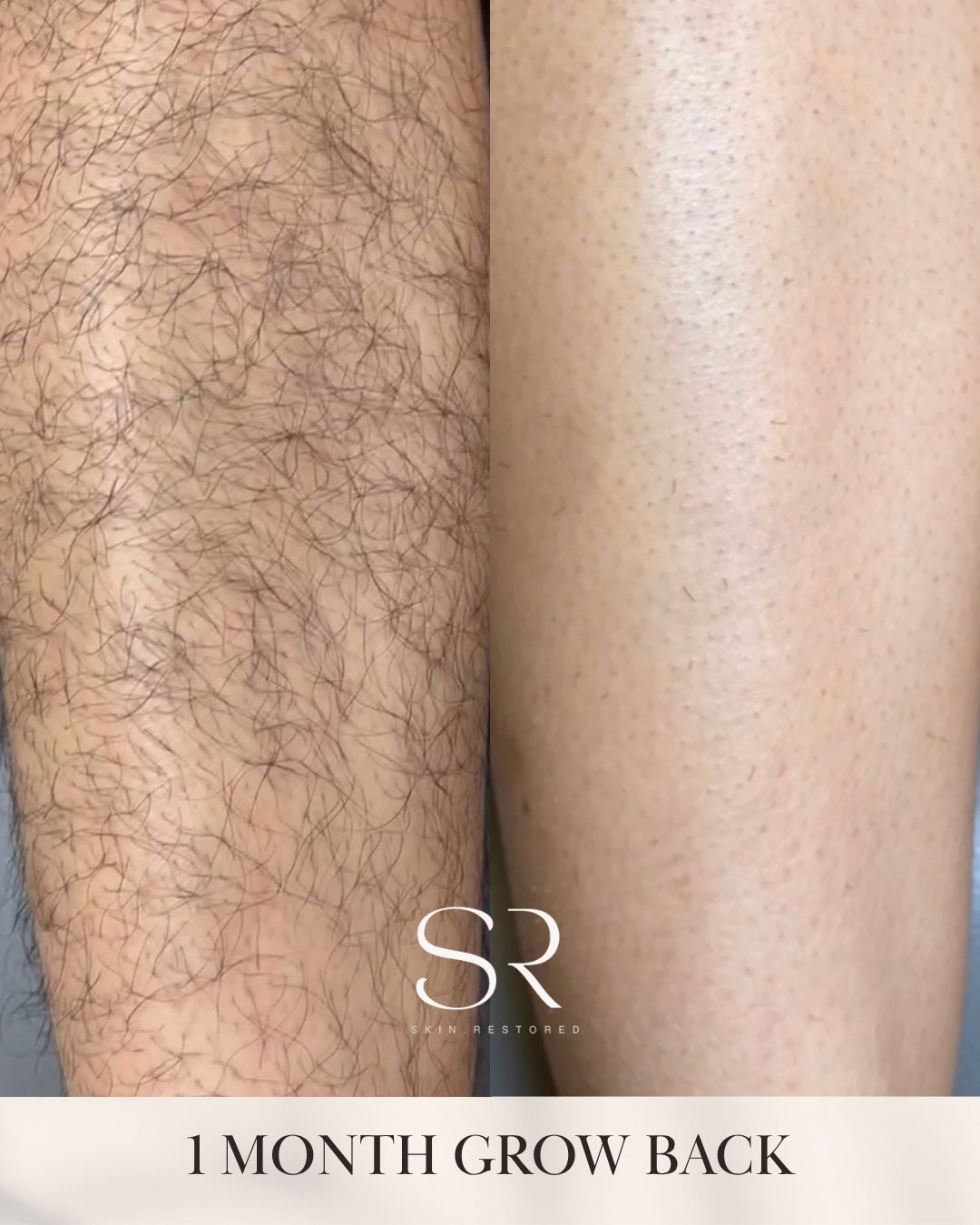 Summer prep starts now. ☀️

This is your sign to stop shaving every few days and start investing in long-term smooth skin. Laser hair removal helps reduce hair growth, minimize ingrowns, and leave your skin feeling softer and more even over time.

Ju