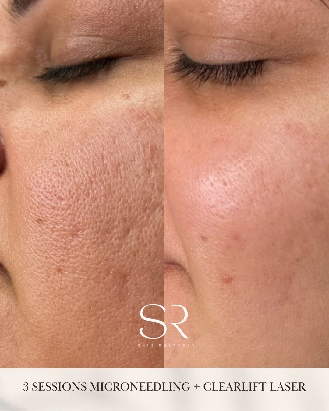 Texture, pores, and acne scars, this is your sign it can get better.

This transformation is after 3 sessions of Microneedling + ClearLift Laser, a powerful combo that works beneath the surface to stimulate collagen, refine texture, and improve overa