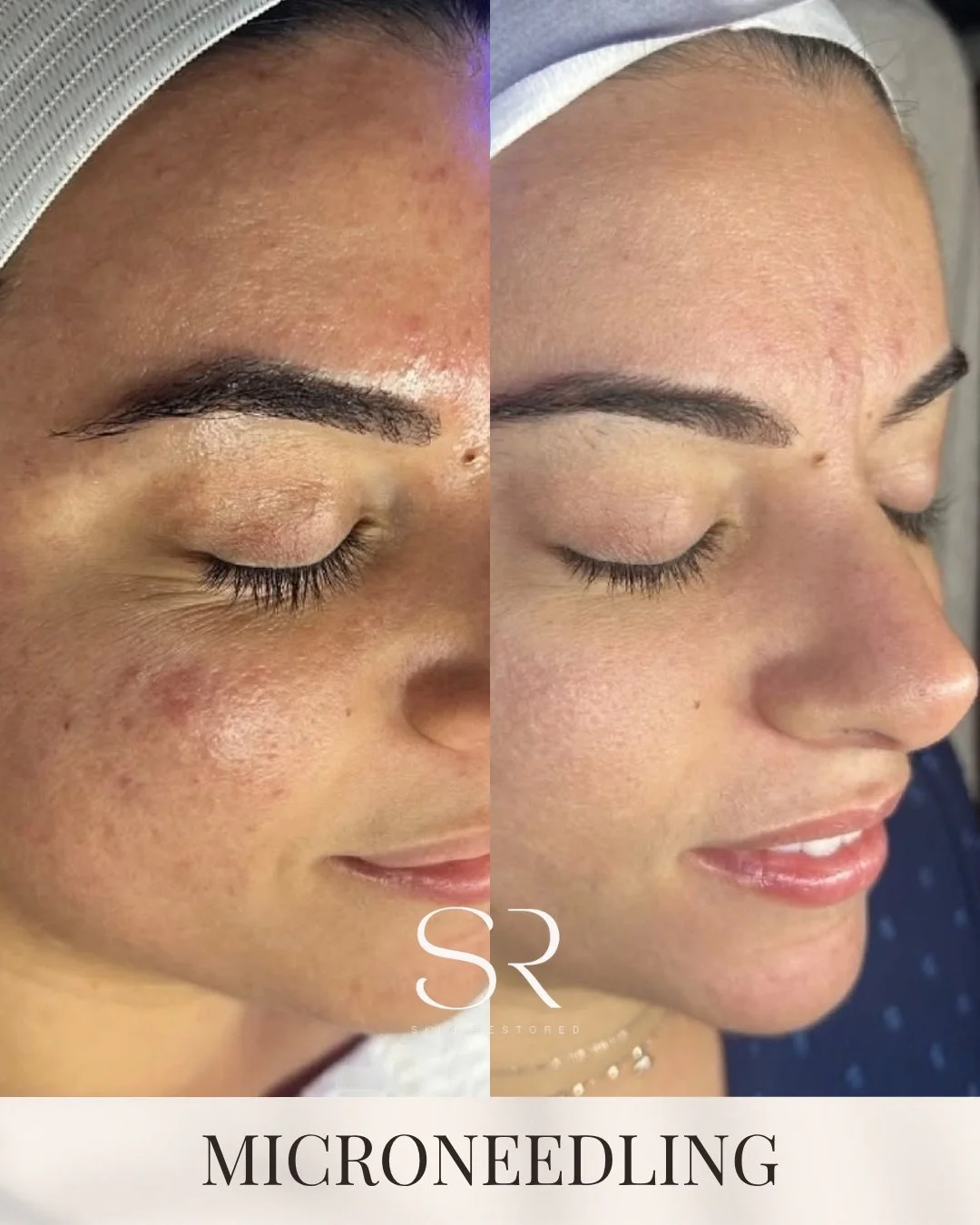 This is what consistency looks like 👀

From breakouts and texture &rarr; smoother, clearer skin. No filters. No shortcuts. Just the right treatments done consistently.

If you&rsquo;ve been thinking about microneedling&hellip; this is your sign to s