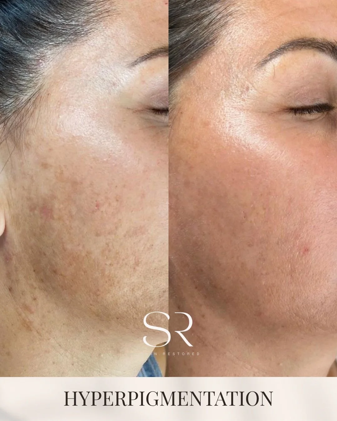 Hyperpigmentation isn&rsquo;t just about dark spots&hellip; it&rsquo;s about uneven tone, texture, and how your skin reflects light.

ClearLift laser works beneath the surface to target pigment while stimulating collagen, helping skin appear brighter