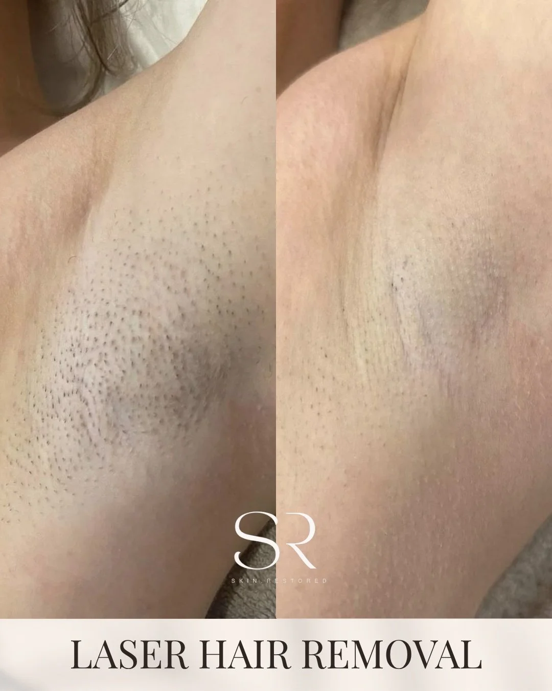 No more shadow. No more irritation. No more constant shaving.

This is what happens when you finally switch to laser hair removal ✨
Smoother skin, fewer ingrowns, and that clean, even look that lasts.

And this is just the beginning&hellip;

Our Apri