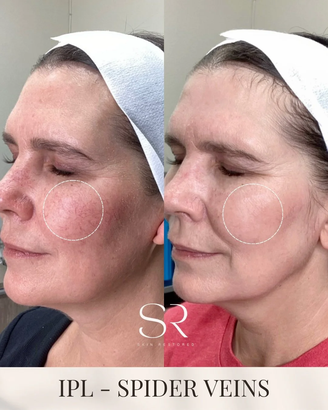 Not all redness is the same&hellip; those thin, visible lines on your skin are called spider veins.

They form when small blood vessels sit closer to the surface, often from sun exposure, genetics, or skin sensitivity. Over time, they become more not