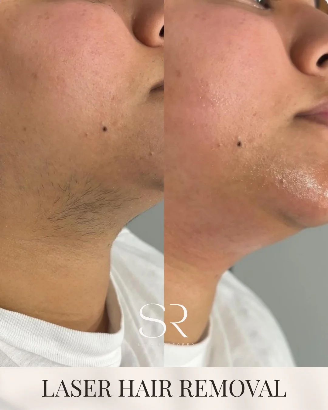 Smoother skin starts with consistency and the right approach.

This treatment helps reduce the appearance of unwanted hair over time while supporting clearer-looking skin and a more even texture.

If shaving and irritation have been part of your rout