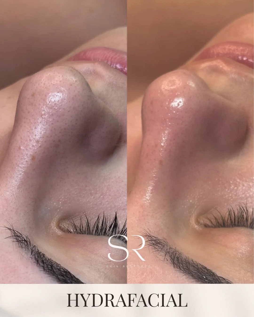 Blackheads, cleared 💧✨
Hydrafacial uses advanced vortex technology to gently lift away buildup, leaving your skin looking smoother, clearer, and refreshed.

Your spring skin reset starts here.

Book now and receive a complimentary dermaplane treatme