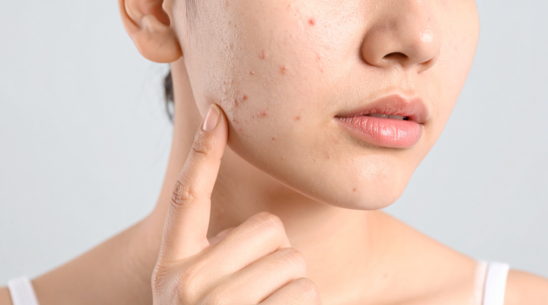 Spring Breakouts: Why They Happen and How to Treat Them