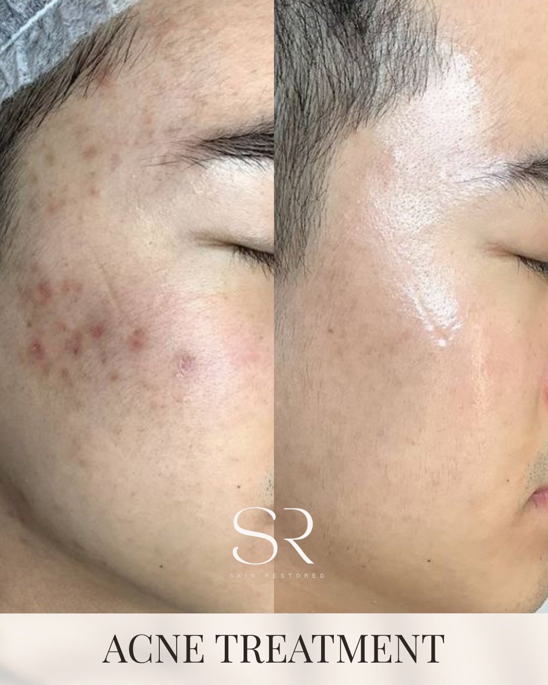 Clearer-looking skin takes the right plan and professional care.

This treatment is designed to support breakouts, improve skin texture, and help your skin look healthier over time.

Every skin journey is different, which is why personalized care mak