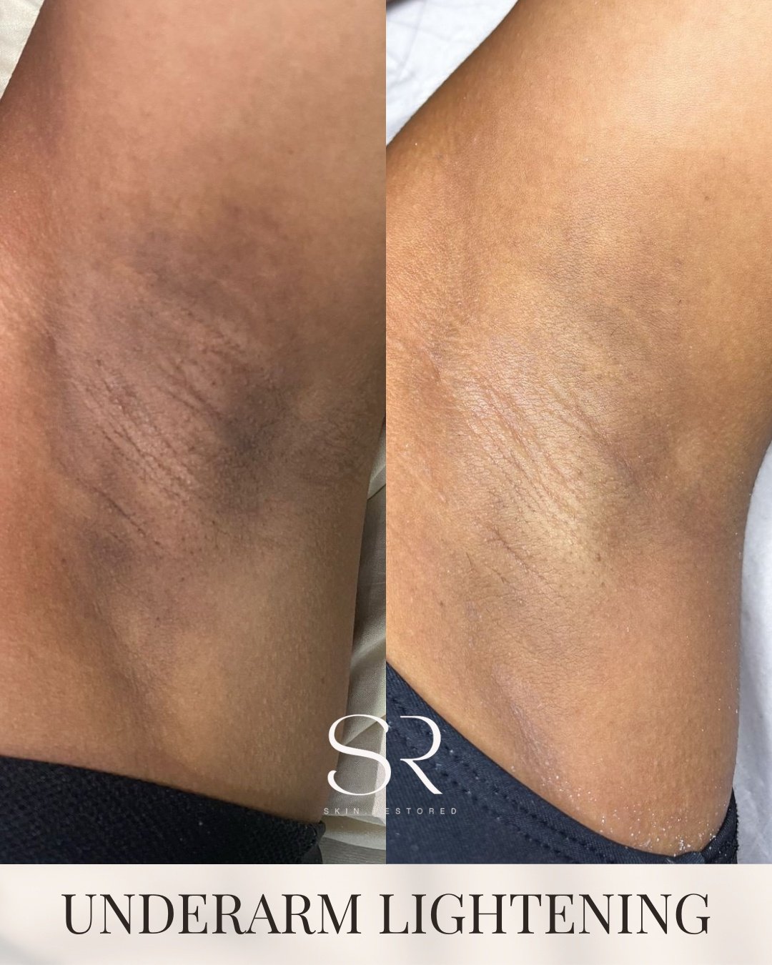 Dark underarms don&rsquo;t happen overnight&hellip; and they don&rsquo;t fix overnight either.
But with the right treatments, real progress is possible.

Smoother, brighter, more even skin without harsh irritation or guesswork.
Consistency is key and