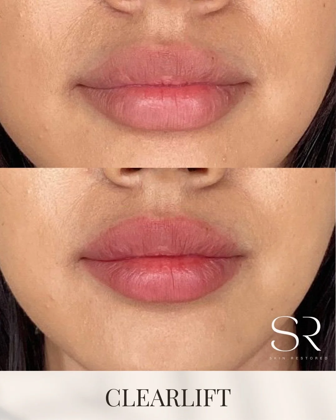 If your lips look darker, uneven, or just not as smooth as before&hellip; it&rsquo;s not always about adding volume.

Clearlift works on the skin around your lips to improve tone, texture, and overall brightness.
No needles, no downtime&hellip; just 