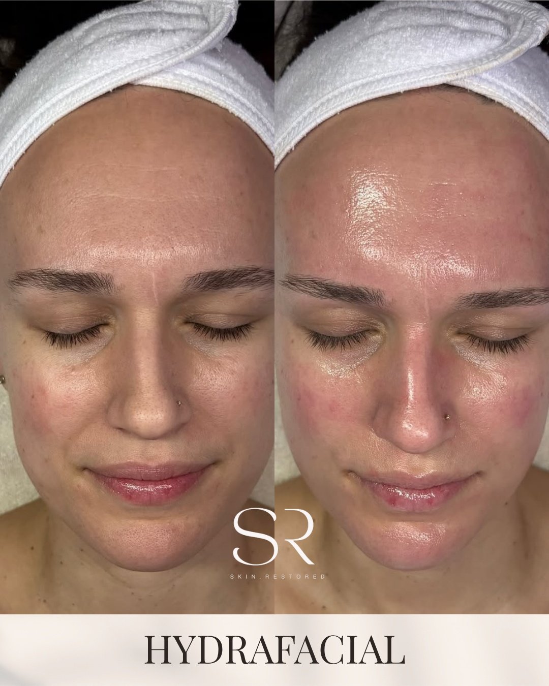Dull, congested skin vs. instant glow.
This is why Hydrafacial is a go-to.

Deep cleanse, exfoliation, and hydration all in one session&hellip; leaving your skin smoother, clearer, and visibly radiant.

No downtime, just results you can see right awa