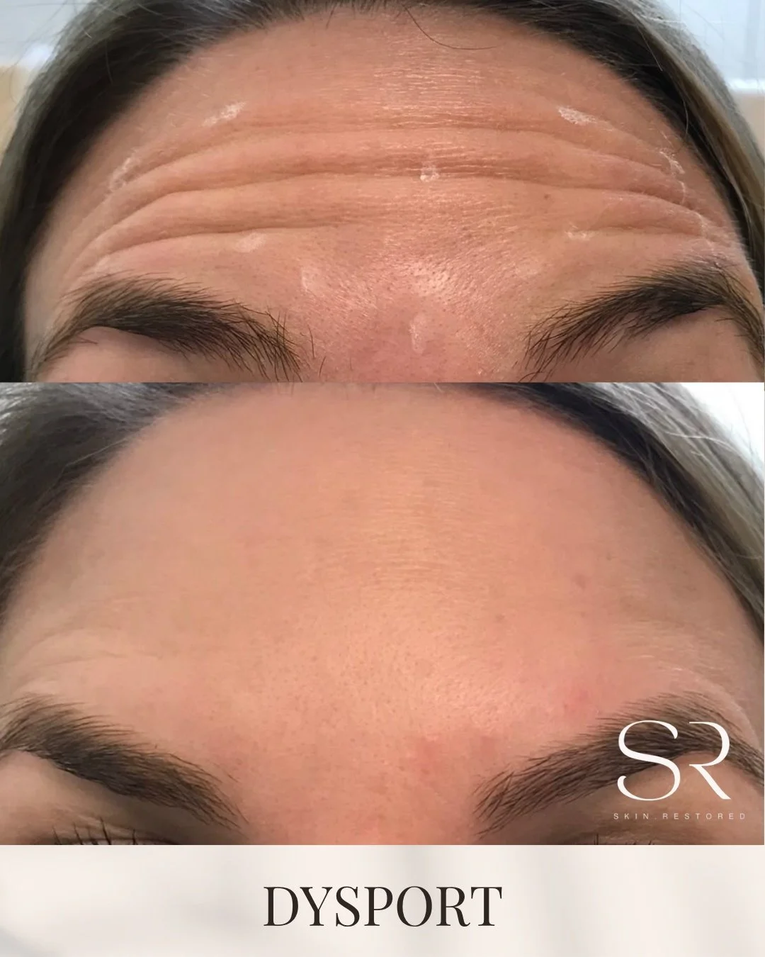 Smooth, wrinkle-free skin is just one session away with Dysport! ✨
Achieve a natural, youthful look by softening forehead lines and crow&rsquo;s feet. Dysport provides fast, effective results with minimal downtime.

Feel refreshed with a treatment ta