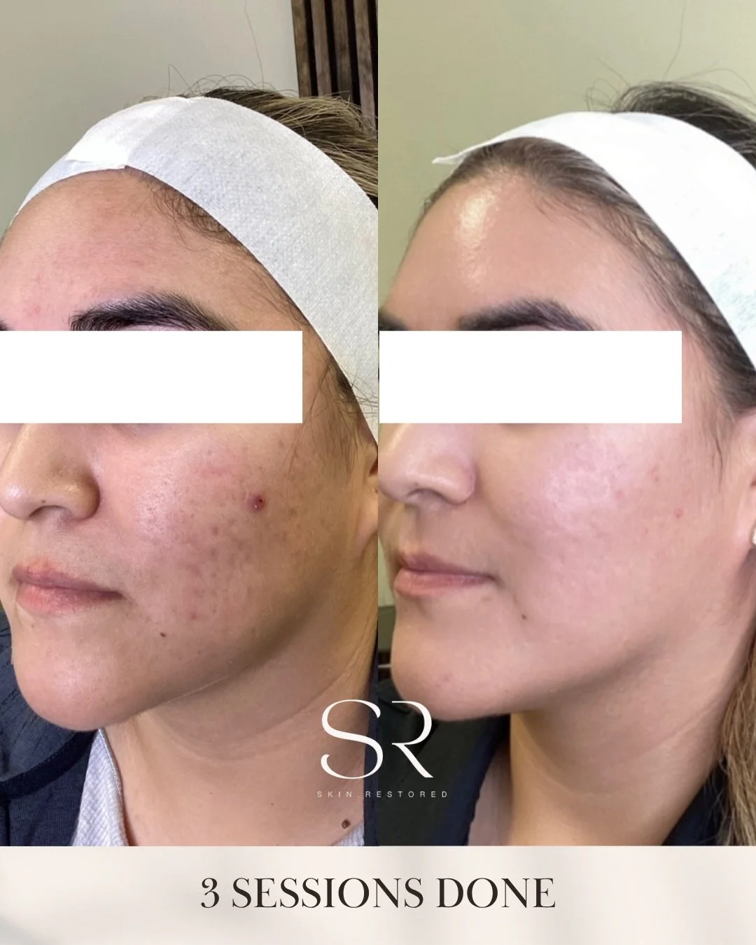 Transform your skin with Microneedling + Exosomes! ✨
See the difference from the first to third session in texture and blemishes. This treatment works wonders for acne scars and skin rejuvenation, leaving you with smoother and more radiant skin.

Rea